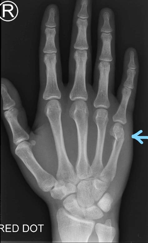 metal boxer for hand|boxer's bone fracture.